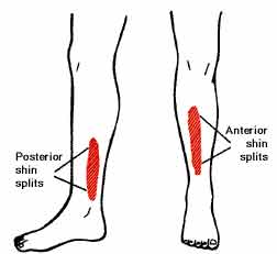 Shin Splits